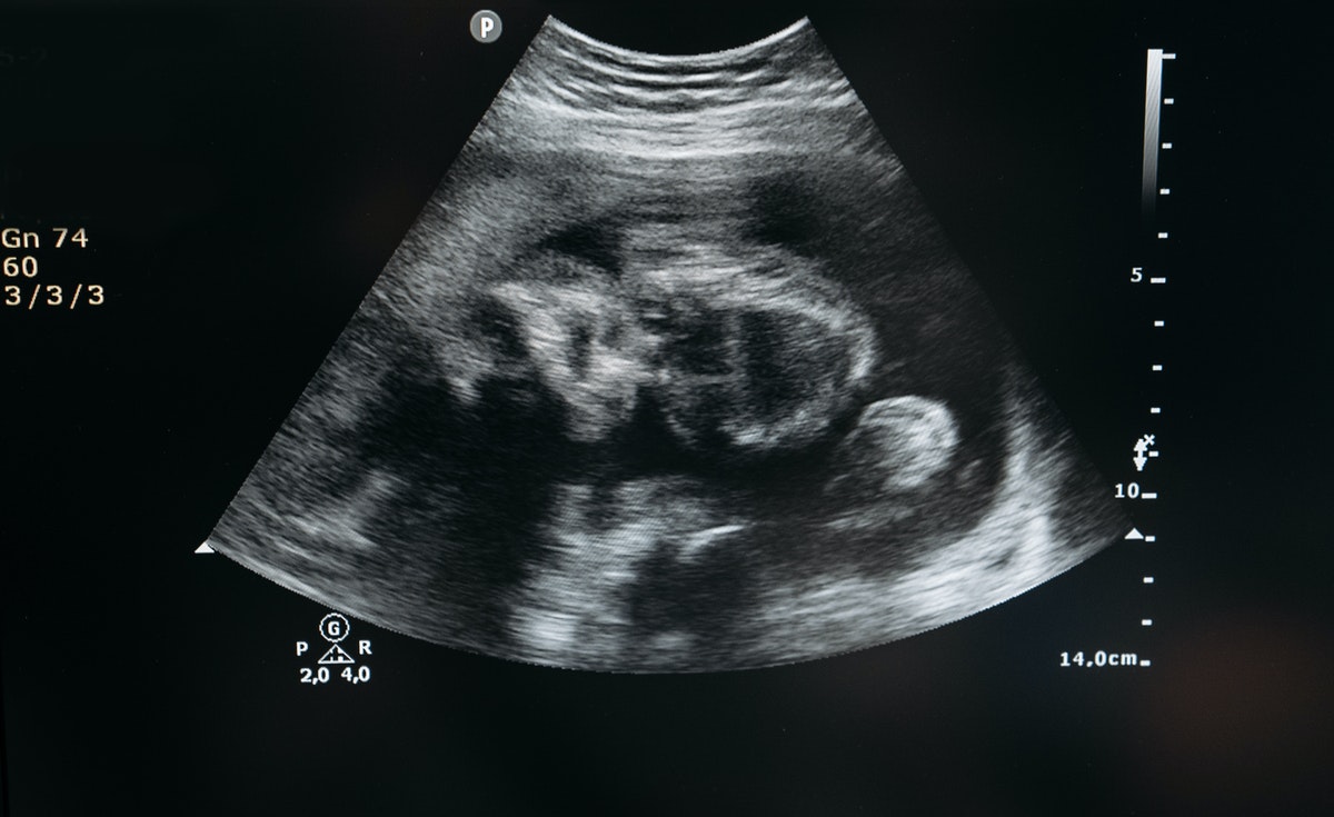 A grayscale ultrasound scan image displayed on a medical monitor, showing the outline of a fetus in the womb. The scene is clinical and emotionally charged, often associated with prenatal care or conversations surrounding pregnancy and abortion.